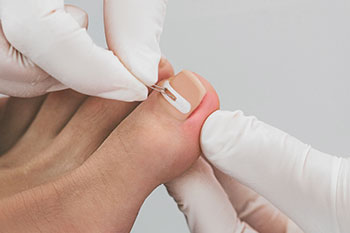 onyfix nail correction system in the Miami, FL 33125 area