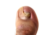 Understanding the Stages of Toenail Fungus