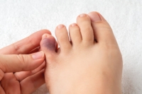 Reasons for a Broken Pinky Toe