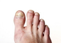 Toenail Fungus and a Podiatrist’s Role